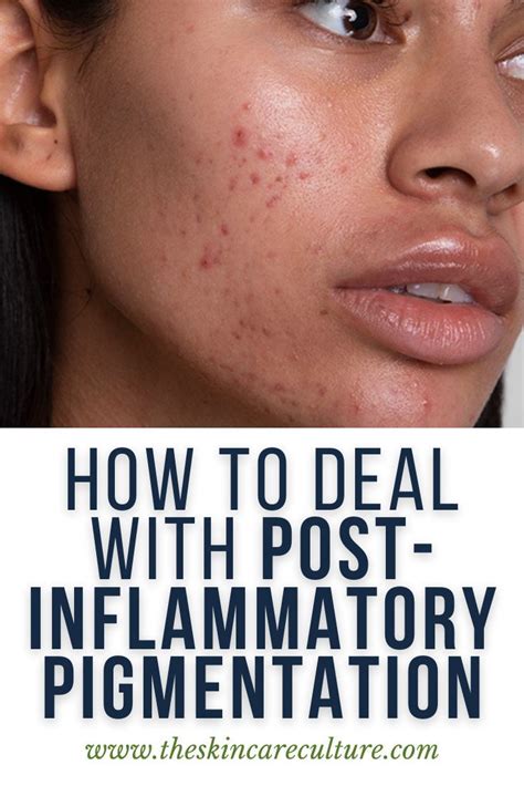 The Main Cause Of Post Inflammatory Hyperpigmentation Pih Is The