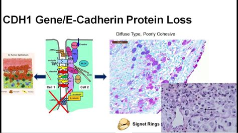 6 What Is The Genetic Basis Of Gec Inherited Vs Acquired Cdh1 Mutation Loss Youtube