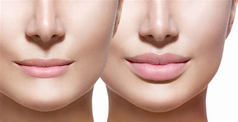 How Long Does Lip Filler Last For Aventus Clinic