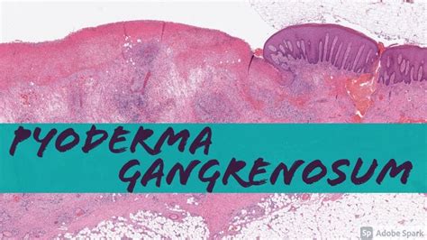 Pyoderma Gangrenosum Vs Non Specific Chronic Ulcer Changes