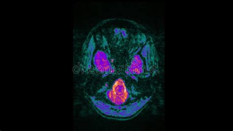 Mri Brain Scan Magnetic Resonance Image Ct Scan Of Human Brain In