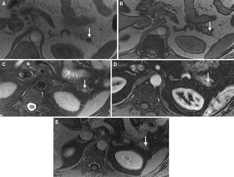 Intrapancreatic Accessory Spleen In An Asymptomatic 45 Year Old Male A