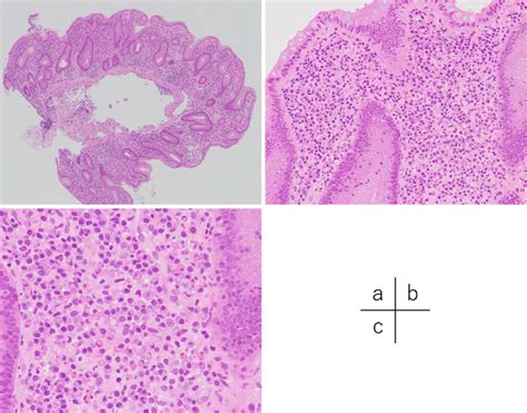 Figure4histological Findings Of Biopsy Specimens From The Descending Download Scientific