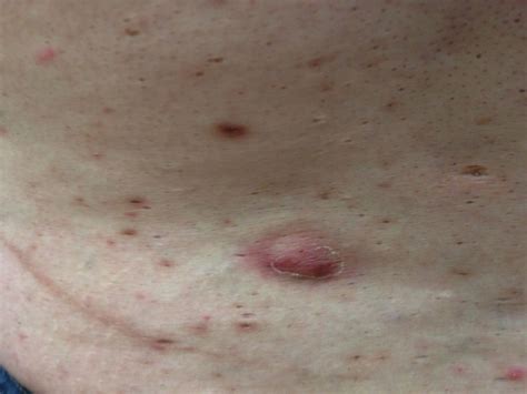 Hidradenitis Suppurativa Stages