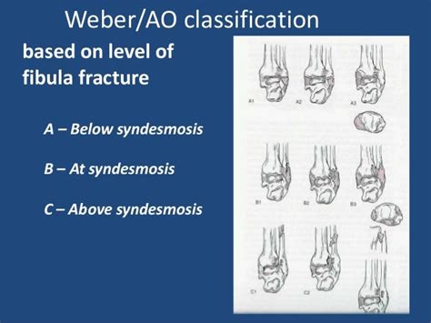 Management Of Acute Ankle Fractures