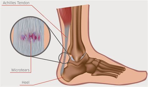 Tendinitis O Tendinosis Causas Y Tratamiento De Las Tendinopatias Images