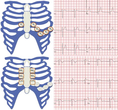 Brugada Syndrome JACC Clinical Electrophysiology