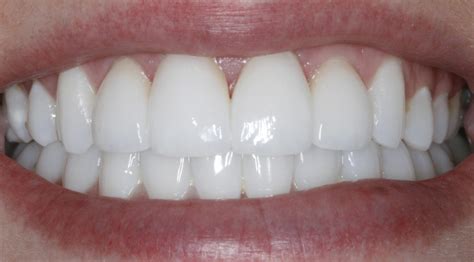 Veneers/Cosmetic Dentistry Brookdale Dental Boise ID