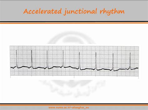 PPT - A Review of Basic Heart Rhythms For Nursing Staff (session 4 ...