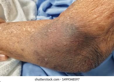 Skin Disease Lesion Ecchymosis Vasculitis Shutterstock