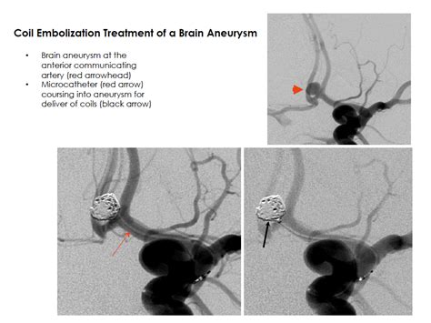 Stroke Neurointervention And Critical Care Neurology Medical