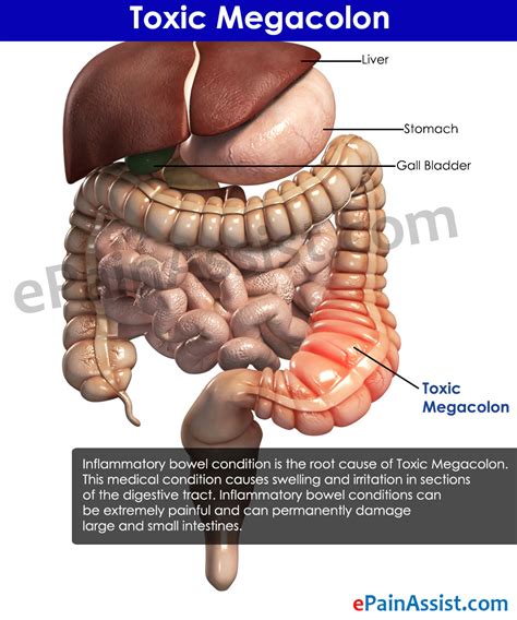 Toxic Megacolon|Treatment|Prognosis|Causes|Symptoms|Diagnosis