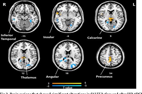 Figure 2 From Repeated Anodal High Definition Transcranial Direct