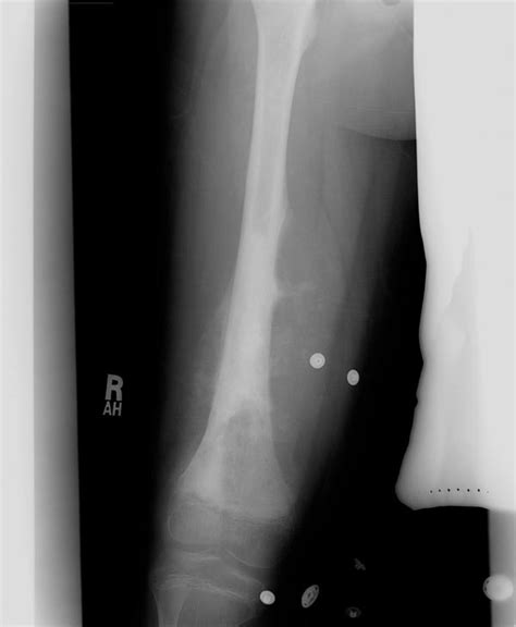 Osteosarcoma x ray - wikidoc