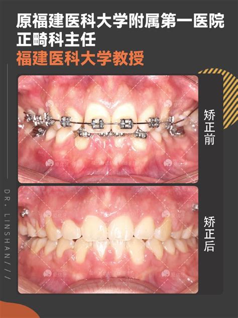 福州牙齿矫正正畸内收上下前牙，改善侧貌。 知乎