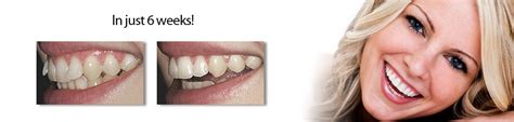 Teeth Straightening With Inman Aligner Hedge End Dovecote Dental Care