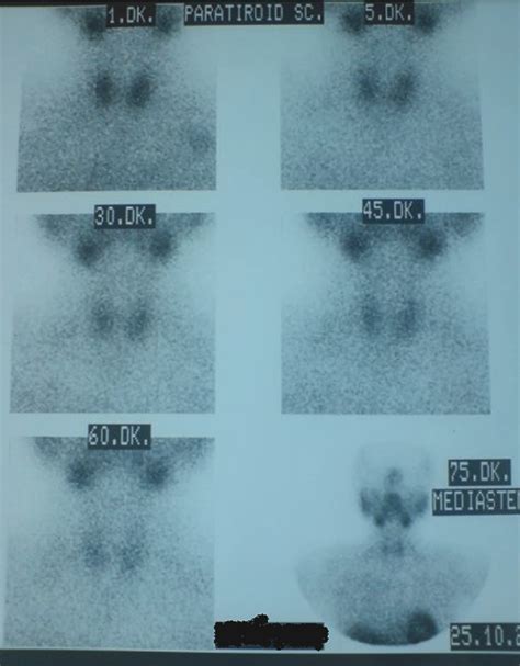 Figure 1 From Bilateral Giant Mediastinal Parathyroid Adenomas Presented With Severe