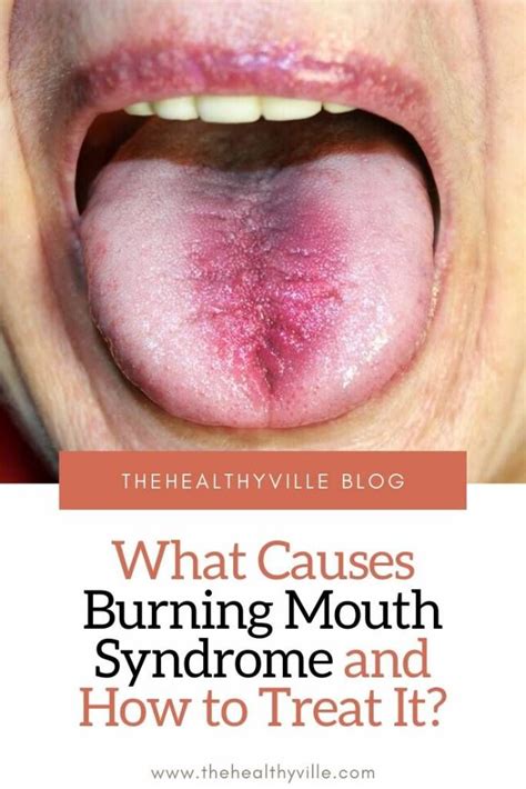 What Causes Burning Mouth Syndrome And How To Treat It Burning Mouth Syndrome Burning Tongue