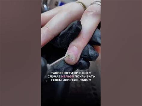 Онихолизис на руках, отходит ноготь от ногтевой пластины ...