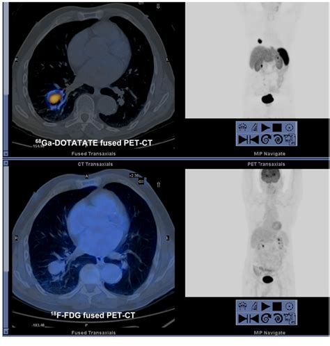 Figure 2 From A Comparison Of 68Ga DOTATATE And 18F FDG PET CT In