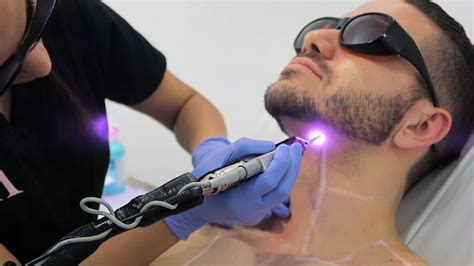 Laser Hair Removal For Men A Guide To Treatments And Cost Dubai