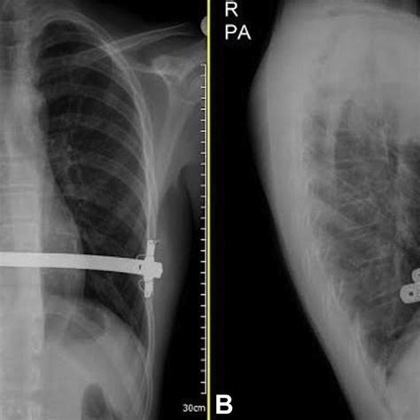 Early Postoperative A Posteroanterior And B Lateral Chest