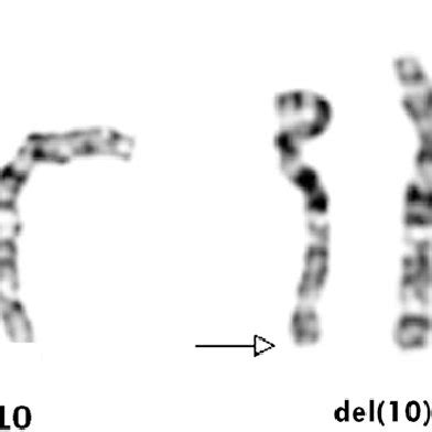 (PDF) Chromosome 10q Deletion del (10)(q26.1q26.3) is Associated with ...