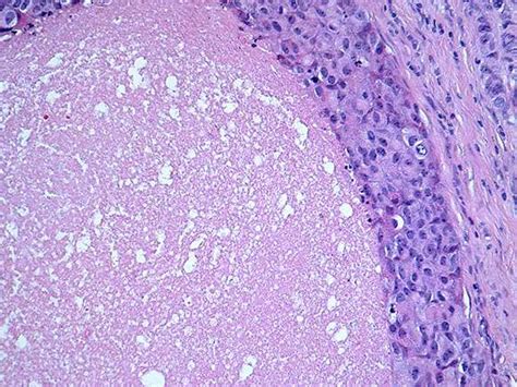 High Grade Ductal Carcinoma In Situ Dcis Bosnianpathology