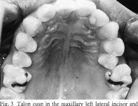 Figure From Multiple Dental Anomalies In The Maxillary Incisor Region