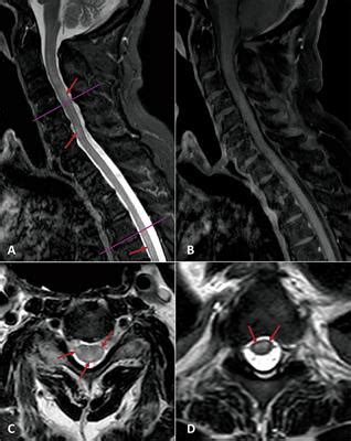 Frontiers Acute Transverse Myelitis Atm Clinical Review Of