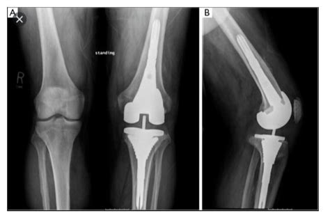 Pros And Cons Of Different Types Of Knee Implants Dr Kurtz