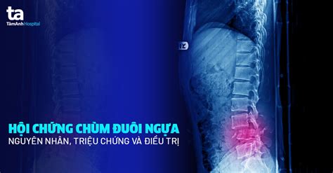 Hội Chứng đuôi Ngựa Nguyên Nhân Triệu Chứng Và điều Trị