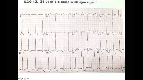 12 Hcm Ekg Ecg Electrocardiogram Dr Ben Zur Youtube