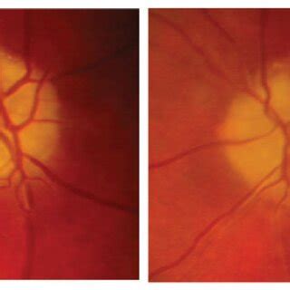 Fundus photos of optic nerve head drusen OU in a patient with severe... | Download Scientific ...