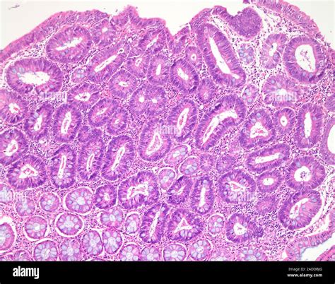 Tubular Colon Polyp Light Micrograph This Specimen Shows Tissue From