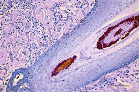 Photomicrograph Of Another Section Of A Biopsy Specimen Obtained From