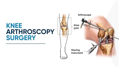 Best Knee Arthroscopy Surgery In Thane Arora Clinic