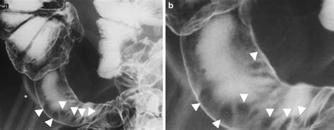 Rose Thorn Ulcers Radiology Plant Thorn Arthritis Plant Thorn