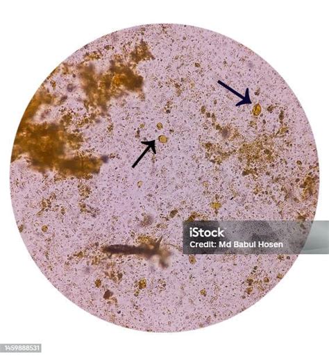 Microscopic Examination Of Stool Showing Blastocystis Hominis Parasite Blastocystosis Stock