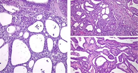 Cribriform Morular Variant Of Thyroid Carcinoma A Neoplasm With