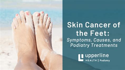 Skin Cancer of the Feet: Symptoms, Causes, & Podiatry Treatments