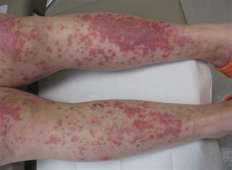 Systemic Lupus Erythematosus Causes Symptoms Diagnosis Treatment