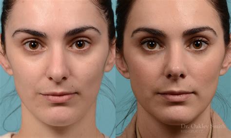 288a Rhinoplasty Dr Oakley Smith Toronto Nose Job Toronto