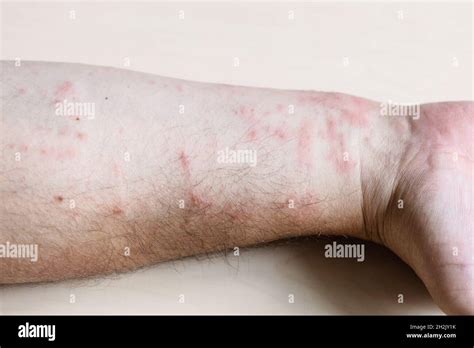 Muestra De Dermatitis Alérgica De Contacto Inflamación De La Piel En