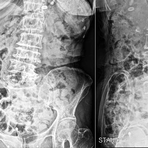 An X-ray showing degenerative scoliosis and compression deformity at L3 ...