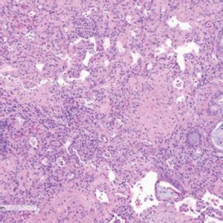 A Photomicrograph Of The Wedge Biopsy From The Lower Lobe Showing