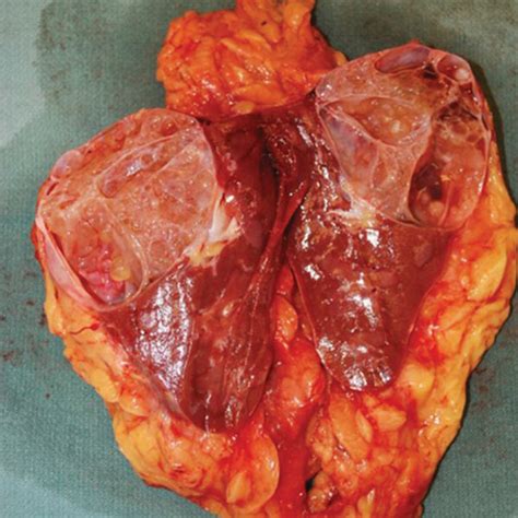 Gross Appearance Of The Tumor A Well Circumscribed Solid And Cystic