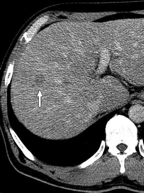 Gadoxetic Acidenhanced Mri Versus Triple Phase Mdct For The