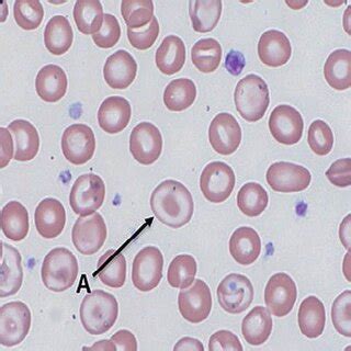 Frottis sanguin avec target cells codocytes flèche présentant un