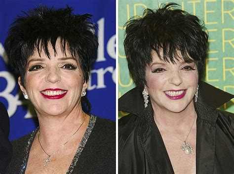 Liza Minnelli Before And After Plastic Surgery